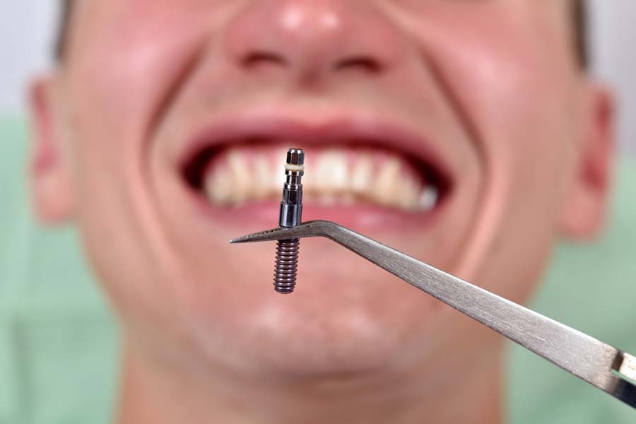 Dental-Implant-tweezers